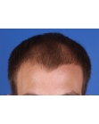 Before Hair Transplant &nbsp;Front